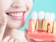beneficios de los implantes dentales